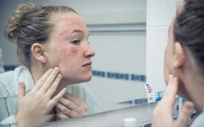 有过敏反应的女人看着镜子里的自己