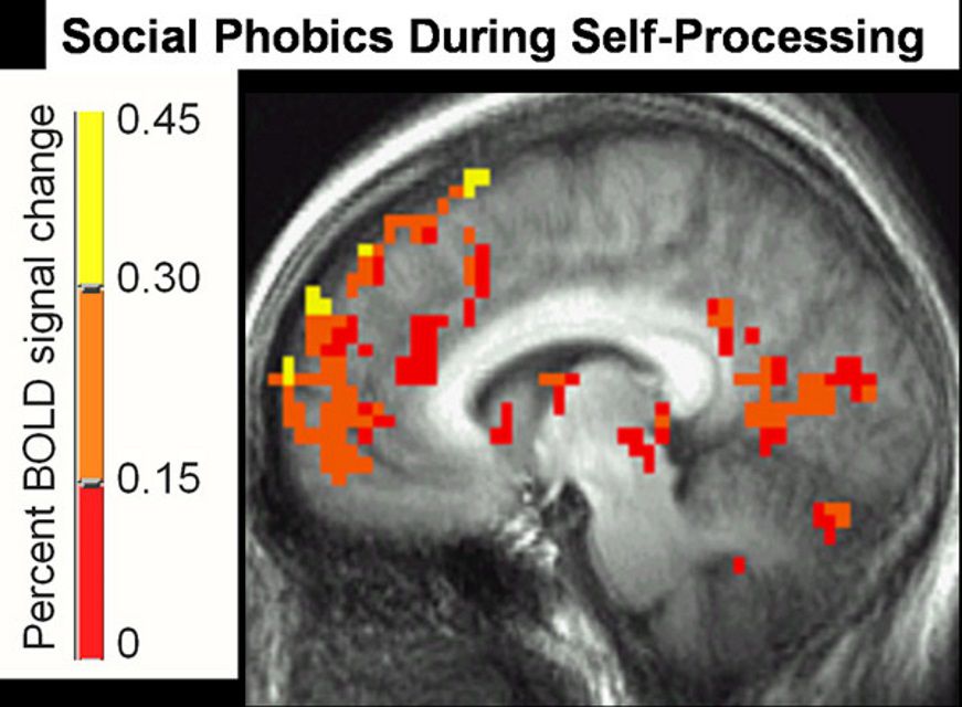 自加工过程中社会恐惧症的脑扫描。