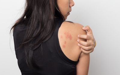 A woman scratching at anxiety hives on her shoulder.
